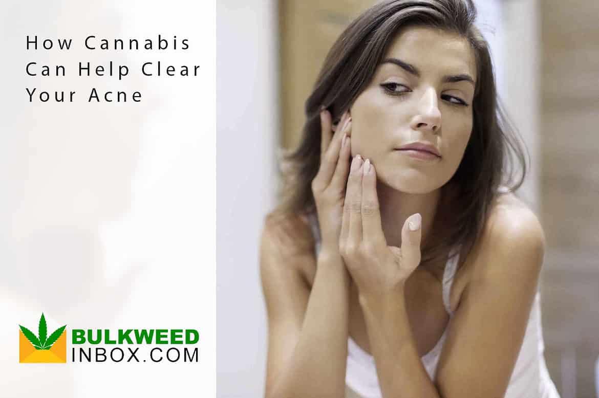 cannabis for acne
